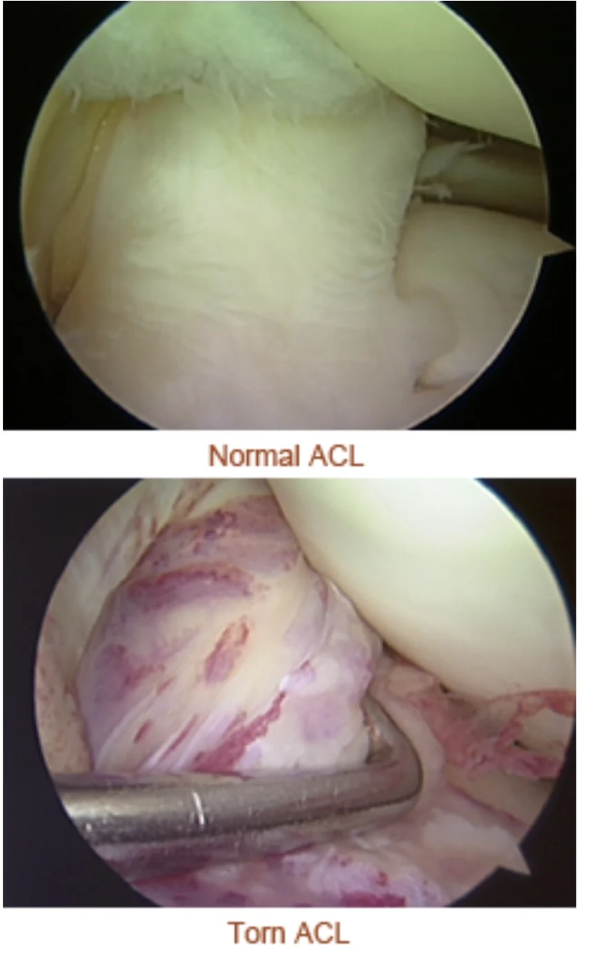 Two arthroscopic views of the inside of a knee: a normal anterior cruciate ligament above, and a torn, frayed ligament below.