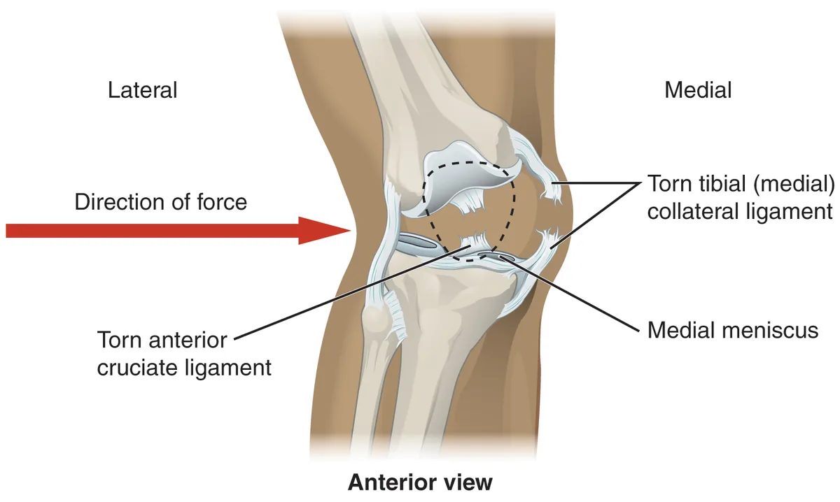 Front view of a knee with a torn anterior cruciate ligament, a torn medial collateral ligament and a damaged medial meniscus after a sideways force.