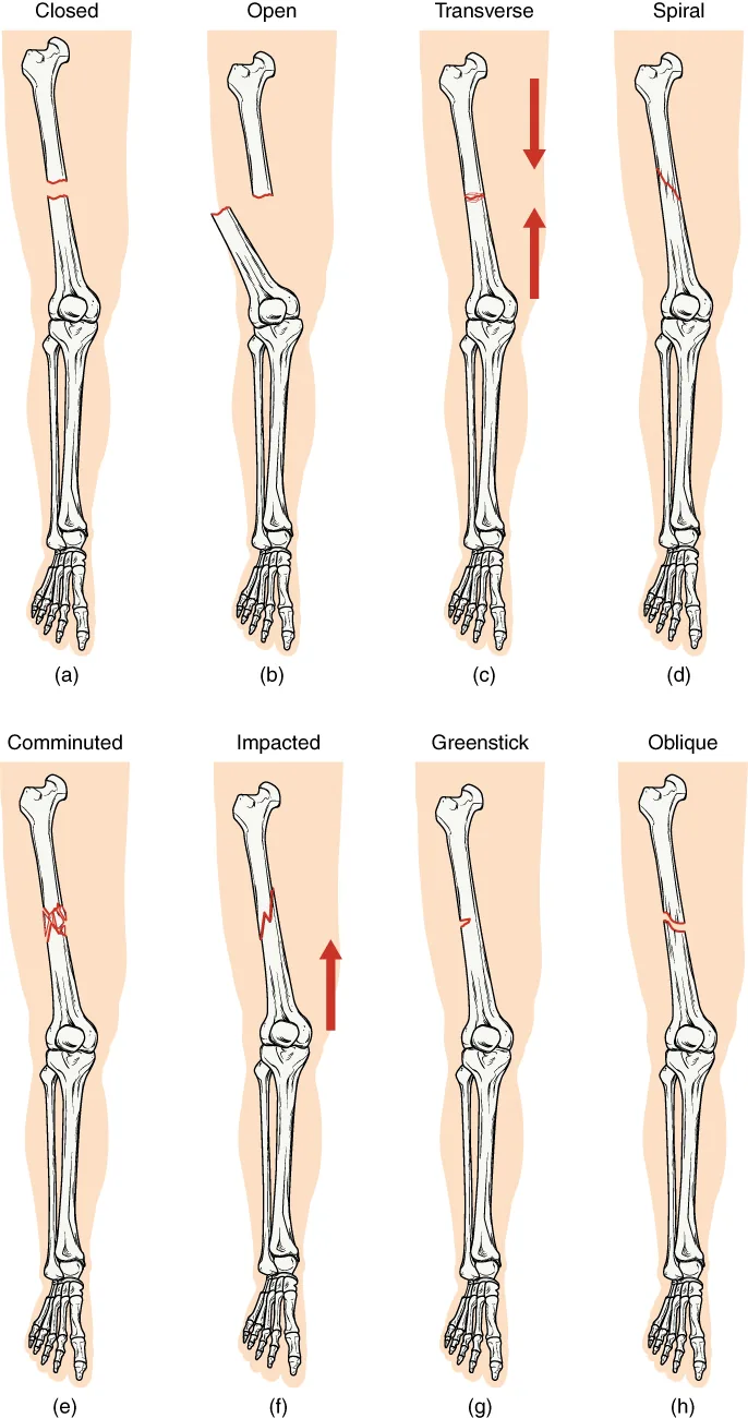 Diagram of common fracture types: transverse, oblique, spiral, comminuted, impacted, greenstick and open.