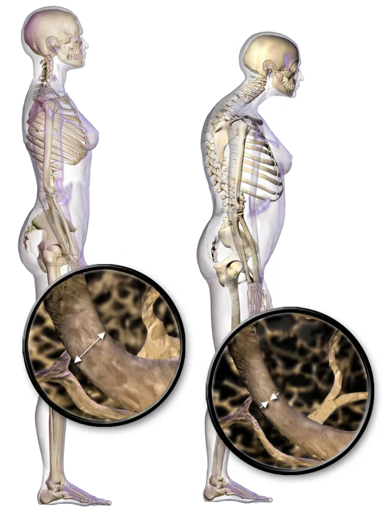 Illustration comparing normal bone structure with the thinner, more porous structure of osteoporotic bone.