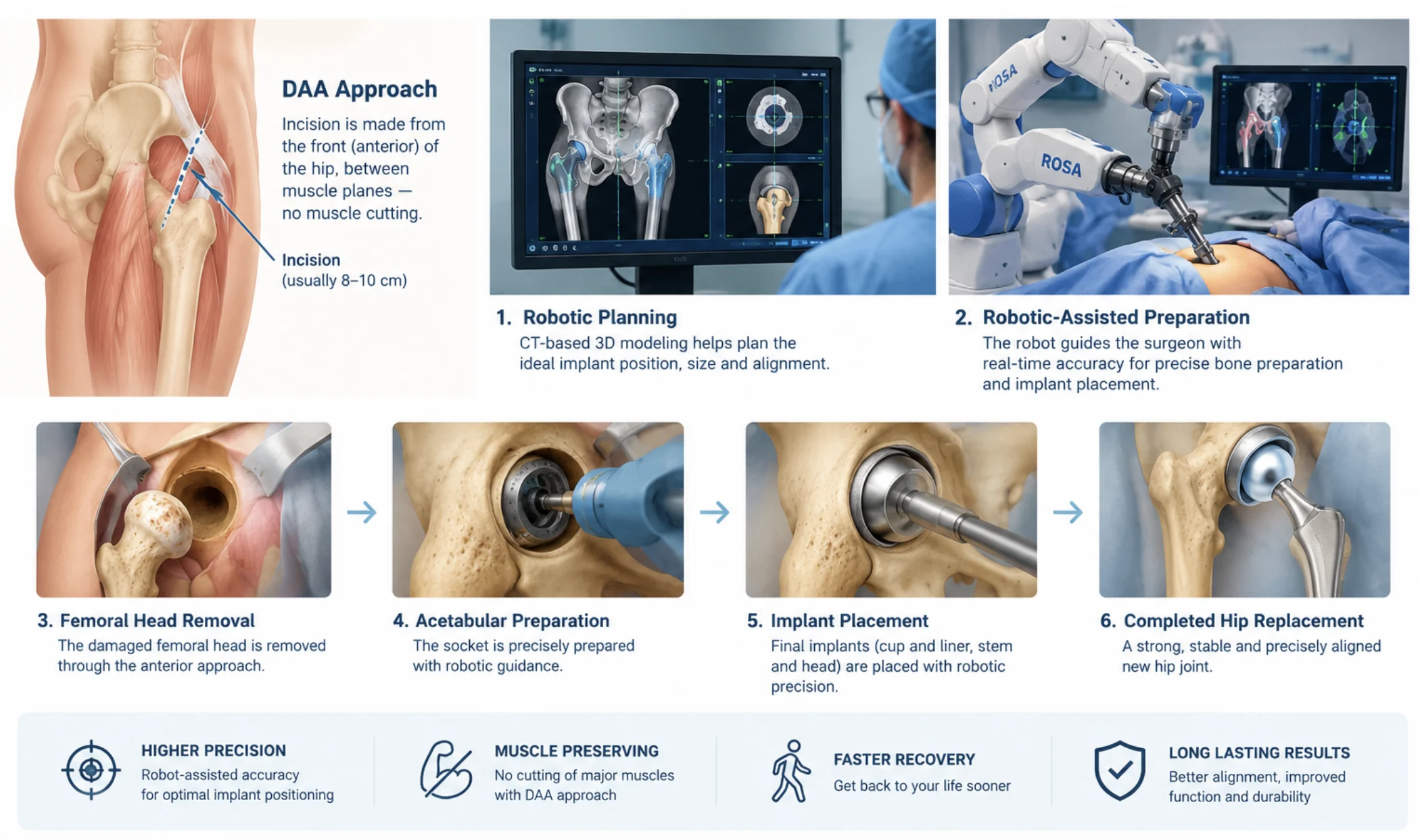 Robotic hip replacement by the direct anterior approach, step by step: the front-of-hip incision between muscle planes, CT-based robotic planning, robotic-assisted bone preparation, removal of the worn femoral head, preparation of the socket, implant placement and the completed joint.